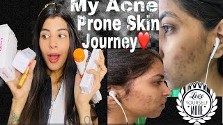 My Acne Prone Skin Journey 6 Years Accident Love Yourself [upl. by Otreblaug]