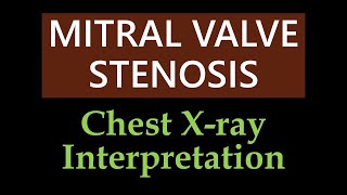 Mitral Valve Stenosis  Chest Xray Interpretation [upl. by Harriman]