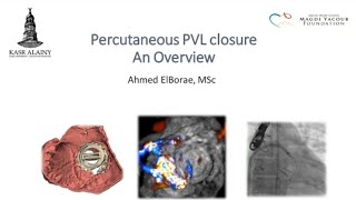 Percutaneous paravalvular leak closure [upl. by Hooker]