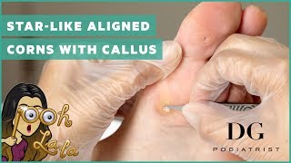 Starlike aligned corns with callus [upl. by Rhona279]