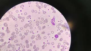 Thrombocytosis under microscopic slide amp haemoglobin concentration detection by RBC size amp shape [upl. by Llerud]