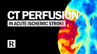 CT Perfusion In Acute Ischemic Stroke [upl. by Henryetta]