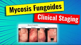 Staging of Mycosis fungoides MF  video series for dermatology residency and USMLE [upl. by Aonian]