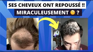 Calvitie  Ses cheveux repoussent en 9 mois avec ce Traitement 😱 [upl. by Saidnac]