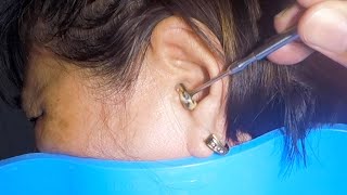 Removing Grandmas 70 Year Old Earwax  Its STUCK [upl. by Gilda]