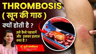 What is Thrombosis Whos at Risk and How to Prevent Blood Clots  Dr Shruti Toshniwal [upl. by Atiuqin]