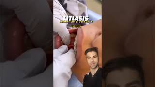 Large Salivary Gland Stone Removal [upl. by Aihsekram]