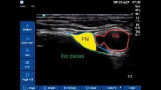 US guided femoral nerve block [upl. by Erme]