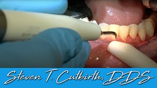 Scaling amp Root Planing  Dental Minute with Steven T Cutbirth DDS [upl. by Ahsea753]