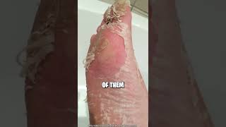 SKIN PEELING 😱 [upl. by Eednas]