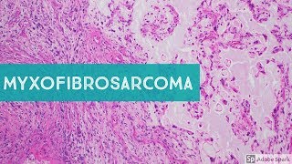 Myxofibrosarcoma 101Explained by a Sarcoma Pathologist [upl. by Chirlin]