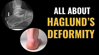 How Do I Treat A Haglunds Deformity [upl. by Ylrebma752]