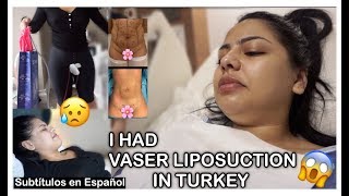 My Vaser Liposuction Journey  Maya Medical  Andrea Roman [upl. by Raclima]