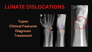 LUNATE DISLOCATION  PERILUNATE DISLOCATION  CAUSES OF DISLOCATION  XRAY EXAMINATION  TREATMENT [upl. by Canty]