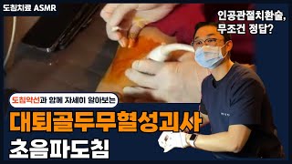 ASMR 고관절의 뼈가 썩는 질환 대퇴골두무혈성괴사 비수술치료인 도침치료로 해결 가능하다 [upl. by Analla]