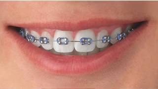 Tipos de Brackets [upl. by Kurt]