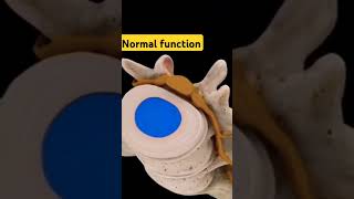 Vertebral Disc Herniation Animation [upl. by Kathryn]