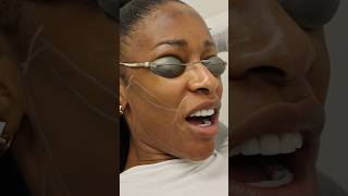 Laser Hair Removal on her FACE [upl. by Francois]