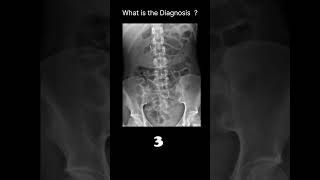 Inferior vena cava IVC filter Abdominal Xray  Abnormal calcification 58 radiologychannel007 [upl. by Akin225]