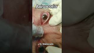 ANISOCORIA medicina seguridad ciencia sabiasque emergency curiosidades tratamientos [upl. by Ecadnarb]