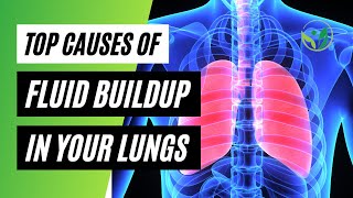 Causes of Fluid Buildup In Your Lungs Pulmonary Edema Causes amp Symptoms [upl. by Louisa]