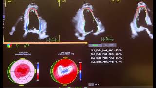 Cardiac Amyloidosis shown on strain [upl. by Assirt]