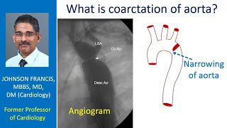 What is coarctation of aorta [upl. by Glad102]