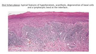 Lecture43 Lichen Planus and Lichenoid disorders Rooks chapter 37 [upl. by Anniala]