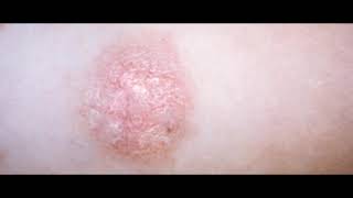 10 Signs of Scabies [upl. by Schwartz]