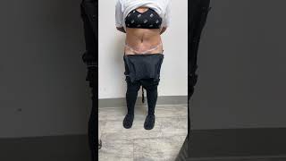 1 DAY AFTER A TUMMY TUCK BY DR GABRIEL PATINO 05 09 20245105257999 [upl. by Eniawd]