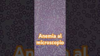 Así se ve la anemia al microscopio hematología anemia laboratorioclinico [upl. by Arim938]