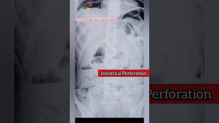 Intestinal Perforation 🤒 Acute Abdomen 😭 Surgical Emergency medical surgeon disease health [upl. by Aaron]