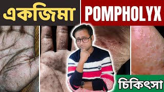 Dyshidrotic eczema  Pompholyx  চিকিৎসা  Dr Supratim Saha [upl. by Bramwell]