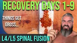 L4L5 Spinal Fusion And Decompression 9 Days After SurgeryThings Are Getting Gross [upl. by Ahsas]