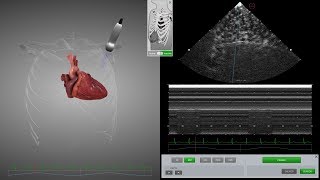 HeartWorks Pneumothorax [upl. by Oilenroc]