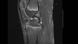 Tibial Tuberosity Apophysitis  Grade 2 Osgoods Schlatters Disease [upl. by Nerot687]