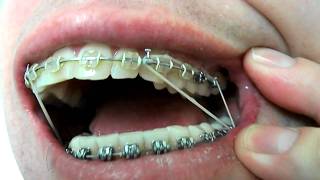 Braces and triangle elastics [upl. by Sylas]