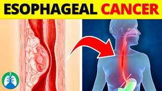 Top 10 Early Warning Signs of Esophageal Cancer  NEVER Ignore THIS [upl. by Attenaz746]