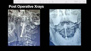 Odontoid Screw fixation Surgical Demonstration Dr Prof Dhiraj Sonawane [upl. by Cutter]