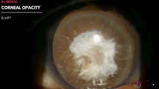 Corneal Opacity  Grading amp Clinical Examination  Adherent Leucoma Nebular Macular amp Leucomatous [upl. by Atnom]