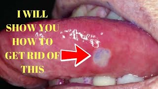 how to get rid of tongue blisters home remedies [upl. by Kissel626]