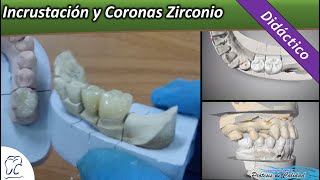 Didáctico 29  Incrustación y Coronas de Zirconio [upl. by Ellehcer620]