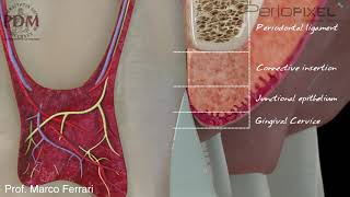 Combined Crown Lengthening with Vertical Preparation [upl. by Gnik]