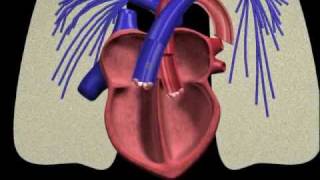 PFO closure animation [upl. by Masterson499]