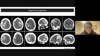 Angiopatia Amiloide Cerebral AVC hCemorrágico e HSA Hemorragia subaracnoidea [upl. by Ring]