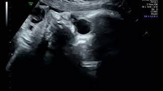 Bilateral Fetal Dacryocystocele  Ultrasound [upl. by Petrick]