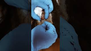 Pilar cyst Trichilemmal cyst How to remove Important video for medical [upl. by Massimiliano]