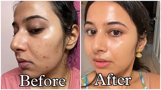 Simple Tretinoin Night Skincare Routine for Acne free Glowing Skin skincare skincareroutine [upl. by Mcgean]