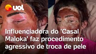 Influenciadora do Casal Maloka faz procedimento agressivo de peeling e troca de pele vídeo [upl. by Llewol284]