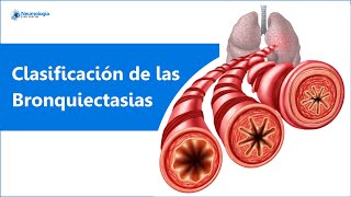 Clasificación de las Bronquiectasias  anatomía  extensión  causa [upl. by Nerok849]